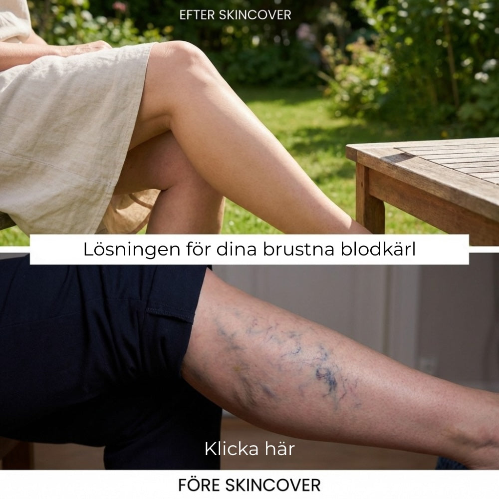 SkinCover™ – Kroppstäckkräm för ytliga spruckna blodkärl, åldersfläckar, ärr, bristningar, blåmärken och andra hudåkommor