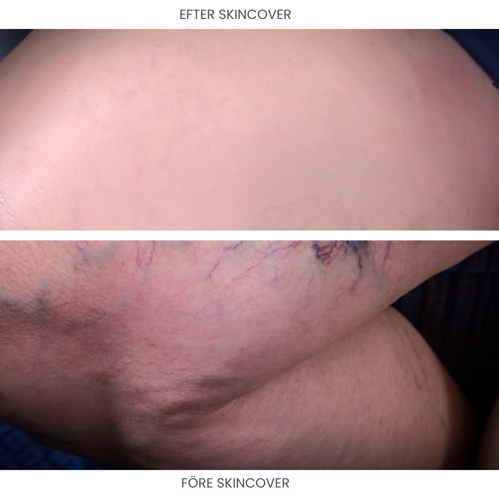 SkinCover™ – Kroppstäckkräm för ytliga blodkärl, åderbråck, ärr, bristningar, tatueringar och andra hudåkommor