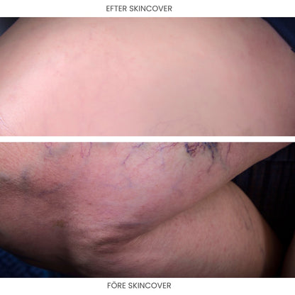 SkinCover™ – Kroppstäckkräm för ytliga spruckna blodkärl, åldersfläckar, ärr, bristningar, blåmärken och andra hudåkommor